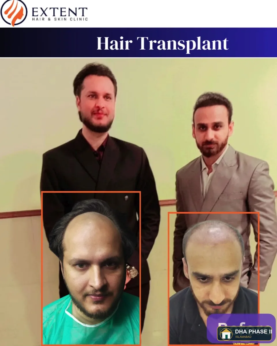 Hair Transplant & Skin Aesthetics Solution Laser Islamabad Pakistan Top Consultant
