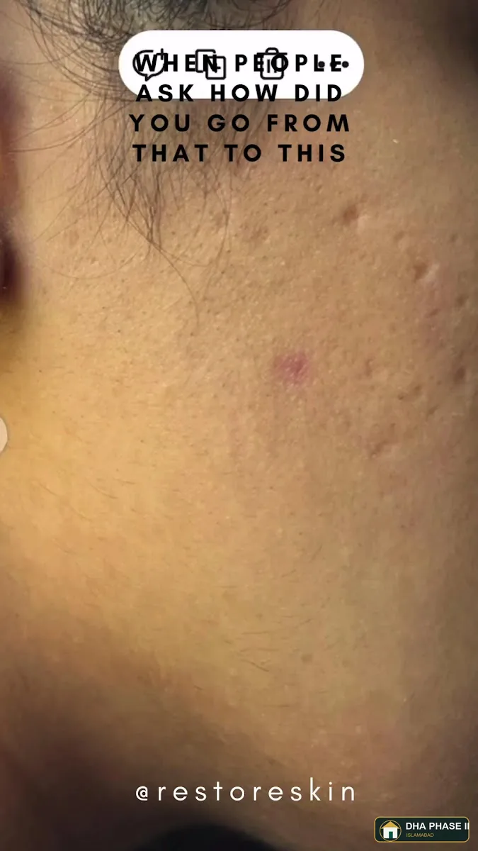 Restore Skin by Dr. Namrah Aziz | FCPS Best Dermatologist in Islamabad in DHA Phase 2 Islamabad — photo 2